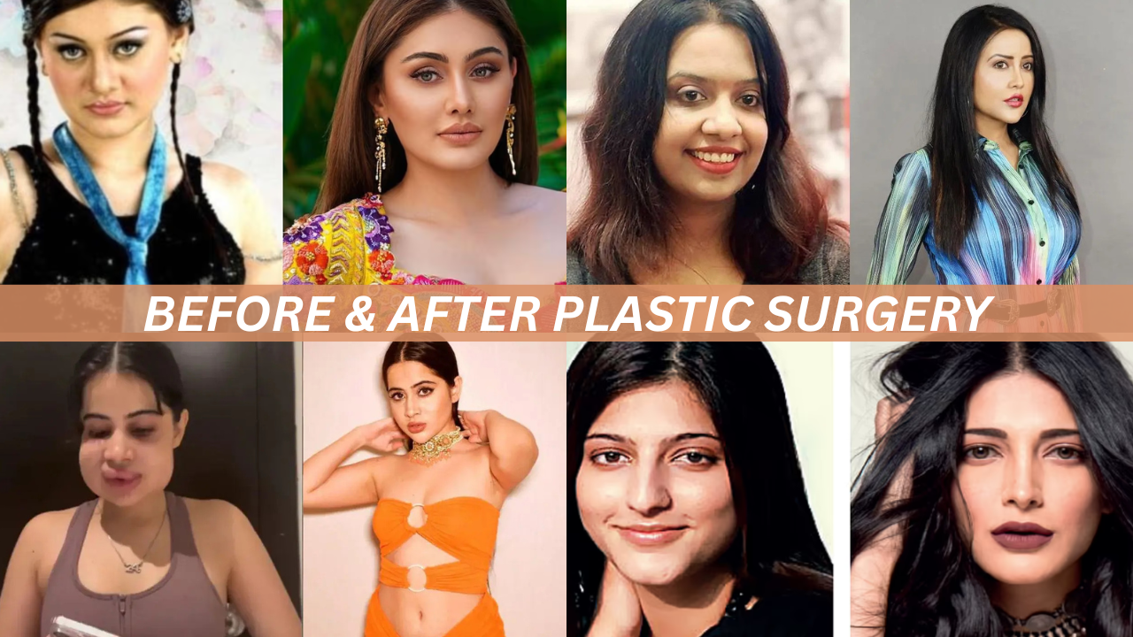 From Bollywood to Hollywood: Celebrity Plastic Surgery Transformations—Before and After Stories